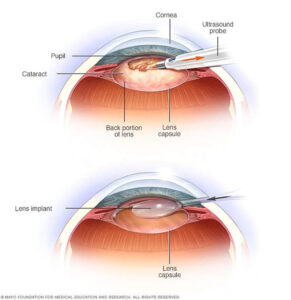 Cataracts Testing & Treatment | Roger A Velasquez MD MPH PLCC