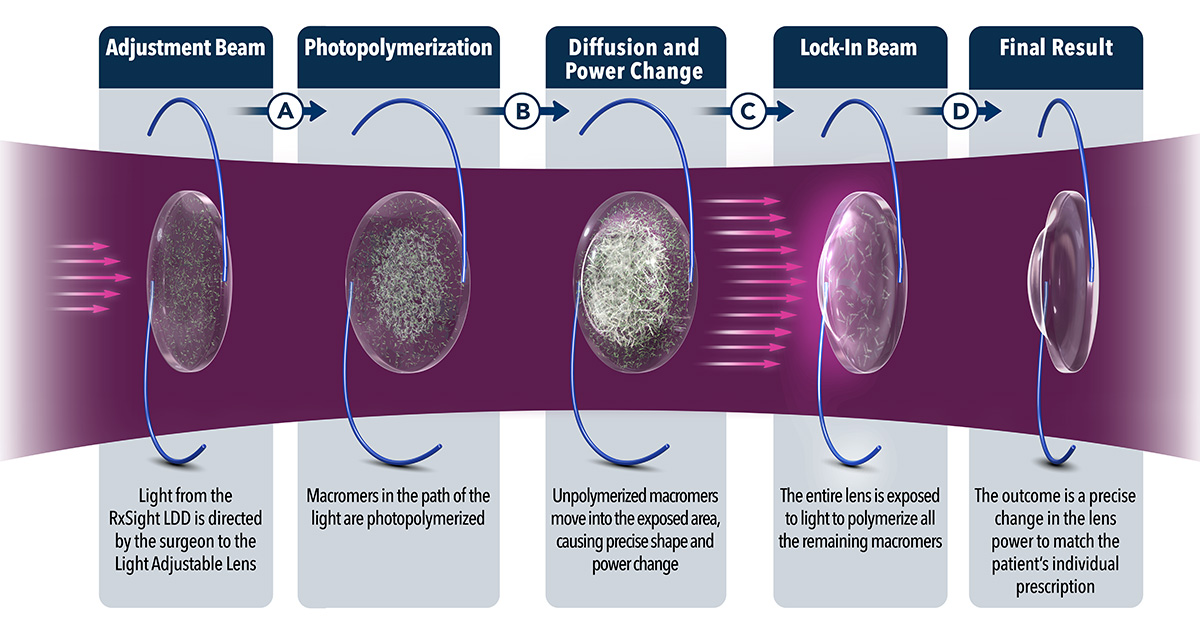 Diagram of how RX Sight Light Adjustable Lens works